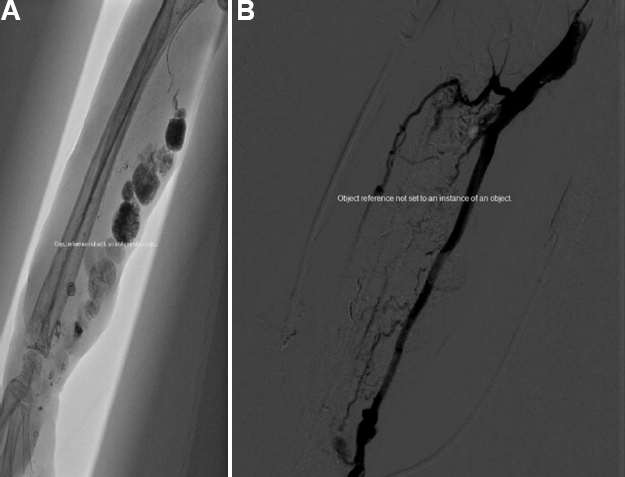 (A) Image showing endovascular embolization of the nidus performed using lipiodol-glue combination. (B) Post-embolization selective digital subtraction angiogram of the right brachial artery showing exclusion of the nidus and glue-cast filling all the feeding branches from ulnar artery and the nidus; normal opacification of the radial artery is seen with residual AVMs which was not embolized to preserve the circulation to the hand.